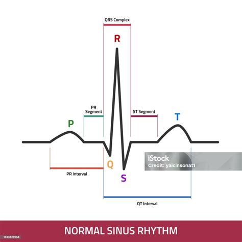 Ekg Showing Normal Heartbeat Wave Ecg Of Normal Sinus Rhythm Infographic Diagram Stock ...
