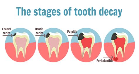 The stages of tooth decay – Dentist Oakland Park, FL