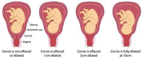 Cervix Dilation During Pregnancy