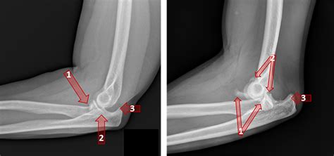 Broken and Dislocated Elbows / Complex Elbow Injuries | Orthopaedic Trauma Association (OTA)