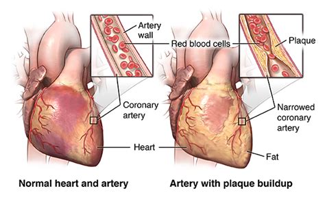 Coronary Artery Bypass Graft Surgery | Johns Hopkins Medicine