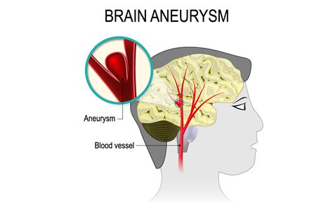 Brain Aneurysm Symptomstreatment Atlantic Brain Spine