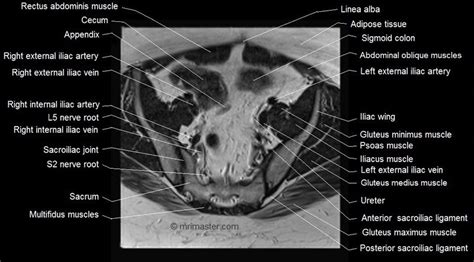 Bony Pelvis Mri