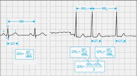 Normal Sinus Rhythm EKG Measurements