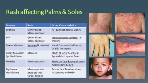 Rash affecting palms & soles… Secondary syphilis | SCVMC IM Chief ...