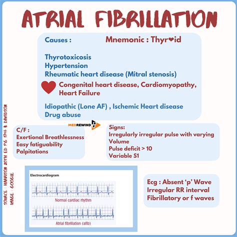 MedRewind - Types of Atrial fibrillation: Paroxysmal,...