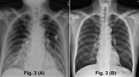 Case 2: chest radiograph showing features of bilateral alveolar edema... | Download Scientific ...