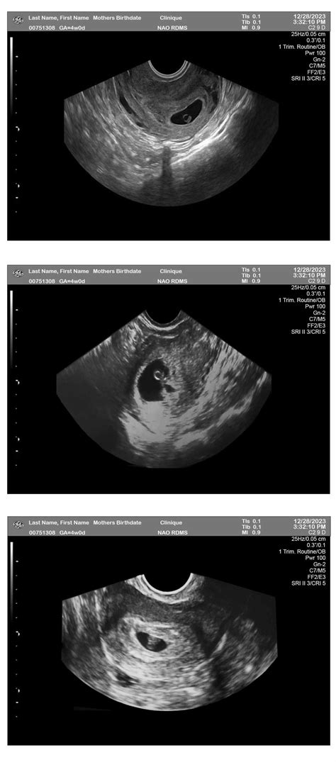 4 Week Sonogram 3-Fetuses - Ultrasounds