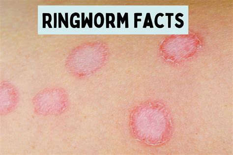 Ringworm: Facts and FAQs