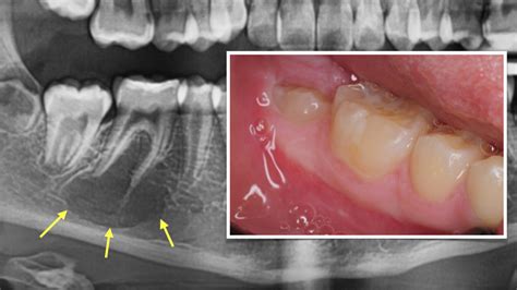 2. traumati simple bone cyst 10 year old jaw bone mandible kazemi oral surgery oral pathology ...