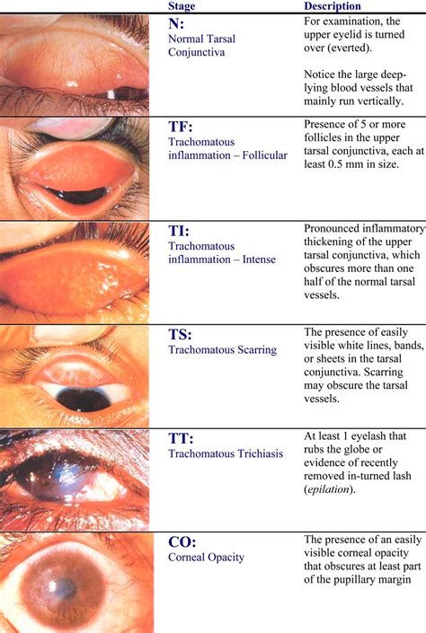 Pin by KA on Ophtha | Eye infections, Eye facts, Diseases of the eye