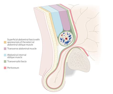 Femoral Canal Hernia