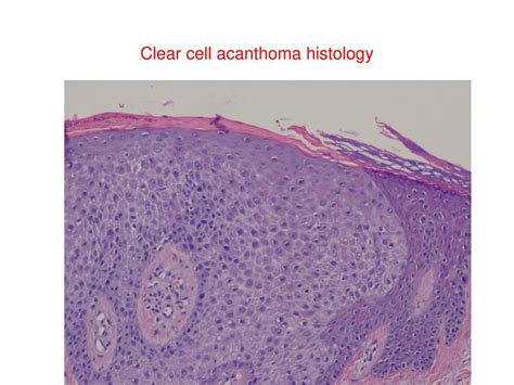 Clear cell acanthoma or Degos' acanthoma - ppt download