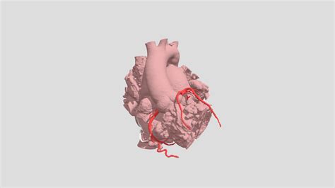 Dextro-Transposition of Great Arteries (H0288) - 3D model by NCHS ...