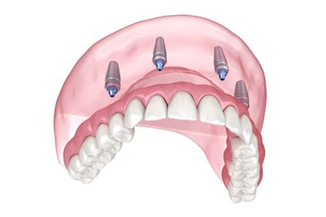 What Can I Expect After the All-on-4® Procedure? - Ivory Dental Albuquerque New Mexico