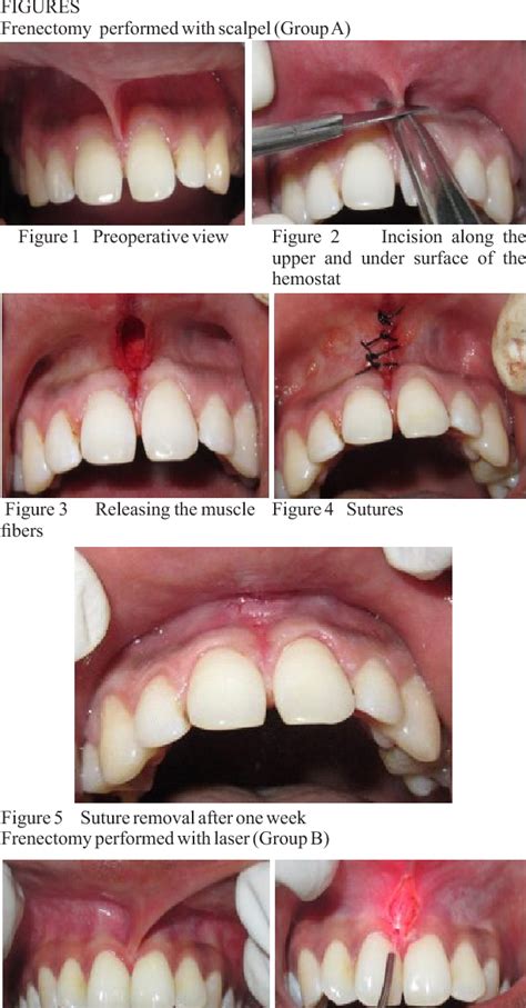 Figure 8 from COMPARATIVE EVALUATION OF FRENECTOMY PROCEDURES PERFORMED ...