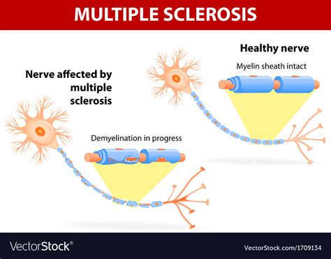 Nerve affected multiple sclerosis Royalty Free Vector Image