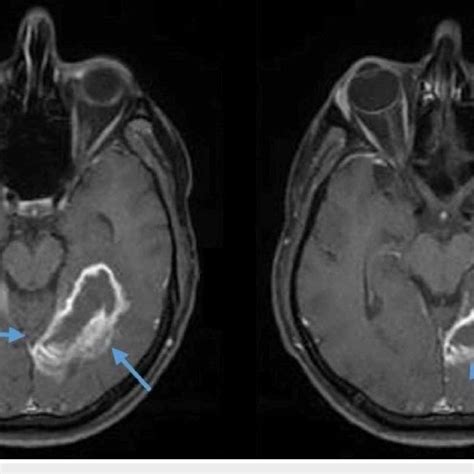 Axial images of the brain MRI showing a ring-enhancing lesion in the... | Download Scientific ...