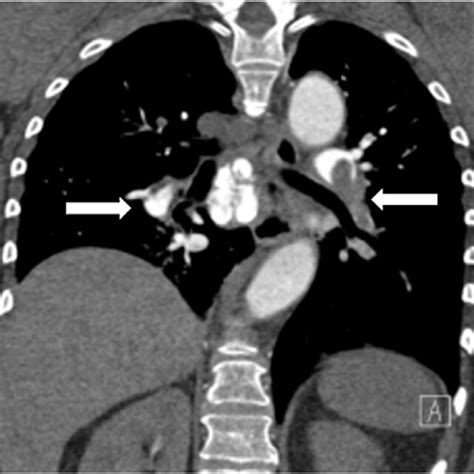 (PDF) A report of 2 cases of the use of the Inari FlowTriever System in ...