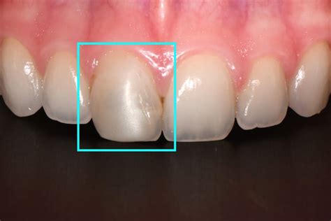 Bonded Composite Restorations - Repairing Your Teeth