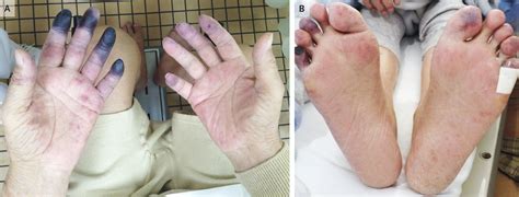 Necrosis of the Fingers and Toes | NEJM