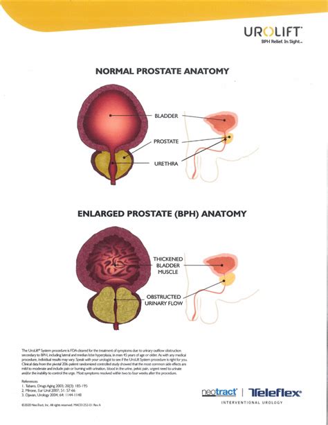 Understanding Enlarged Prostate's Impact | Mason City Clinic