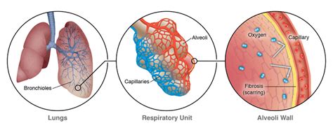 What is ILD? | Interstitial Lung Disease