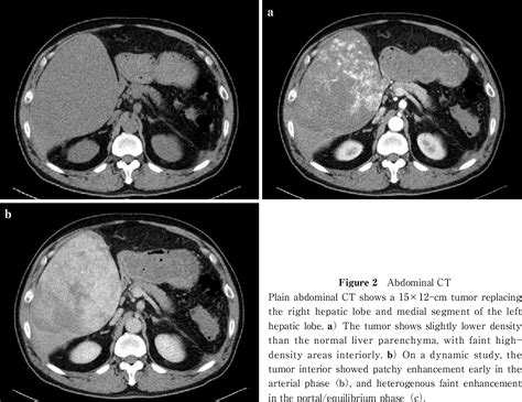 Figure 2 from A Case of Hemangiosarcoma of the Liver which led to a ...