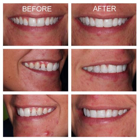 Composite Veneers The Pros Cons Procedure And Cost The Teeth Blog | My ...