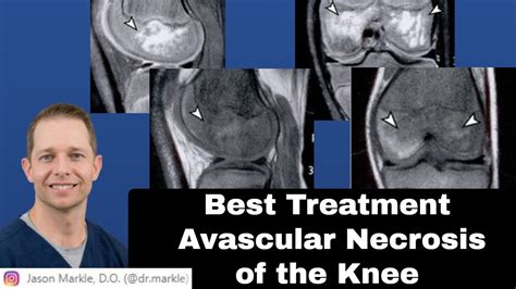 Avascular Necrosis Knee Treatment