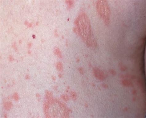 Pityriasis Rosea - Causes, Rash, Herald Patch, Stages, Treatment