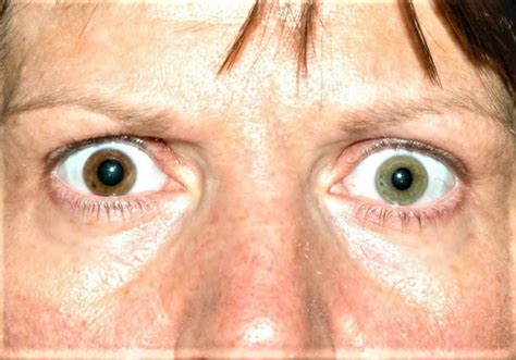 Heterochromia eyes in humans causes, how rare is heterochromia iridis?