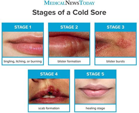 Cold sore on lip - Cold sore on lip Cold sore on lip Cold sore on lip