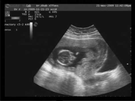 3 months baby ultrasound - YouTube