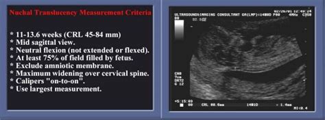 Normal Values for the Nuchal Translucency and Technique for Measurement | Nuchal translucency ...