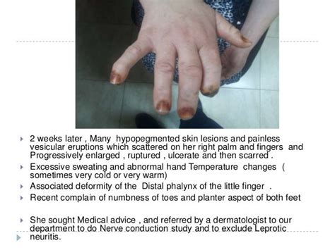 Syringomyelia ( Morvan syndrome) Electrodiagnosis