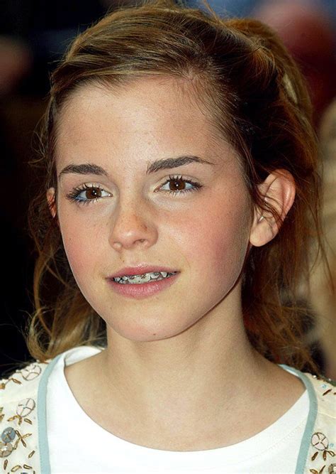 Emma Watson. | Celebrities with braces, Emma watson, Emma watson hair