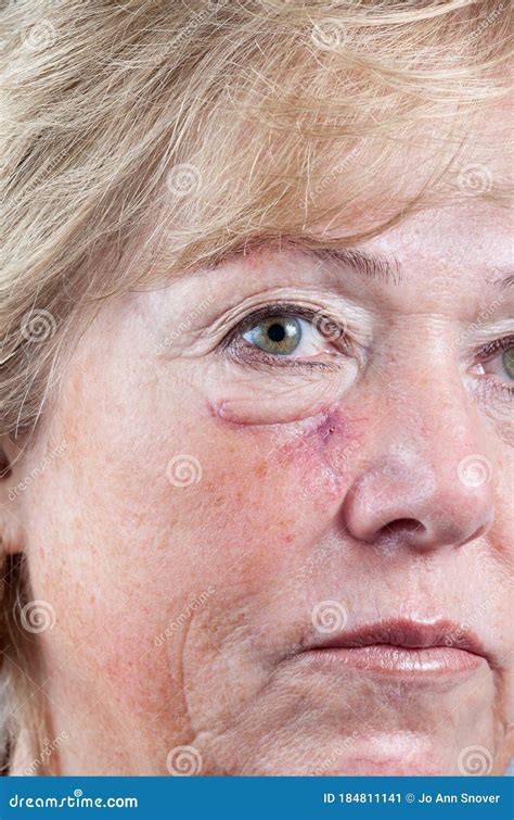 Surgery scar healing stock image. Image of older, cheek - 184811141