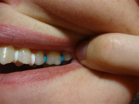 23 year old brace face...: Spacers... oh the pain!