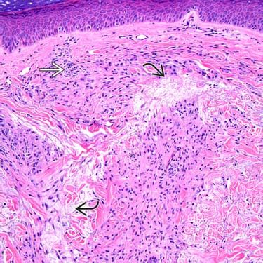 Xanthoma Histology