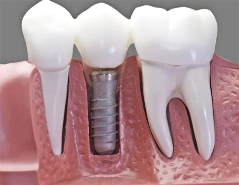 Single Tooth Implants - UpTown Cosmetic & Implant Dentistry