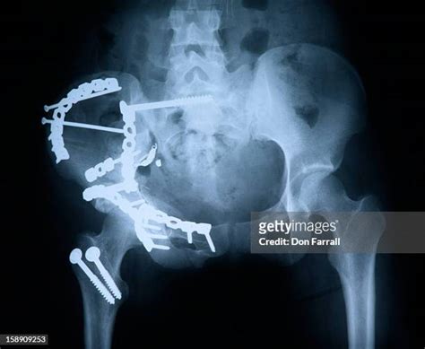 96 Hip Fracture X Ray Stock Photos, High-Res Pictures, and Images - Getty Images