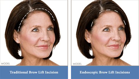 Brow (Forehead) Lift Washington, DC, & Arlington, VA | Potomac Plastic Surgery®