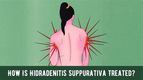 How Is Hidradenitis Suppurativa Treated?