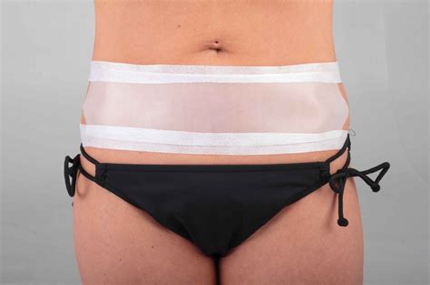 Tummy tuck silicone sheeting scar prevention