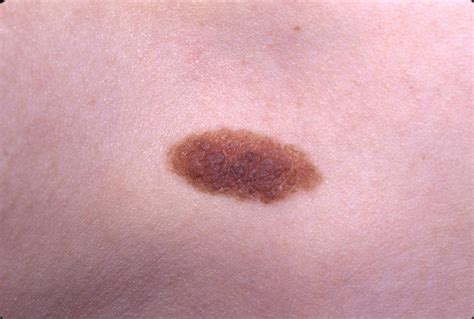 Common Birthmarks - The Clinical Advisor