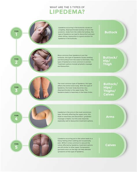 Learn About Stages and Types of Lipedema | Lipedema.net