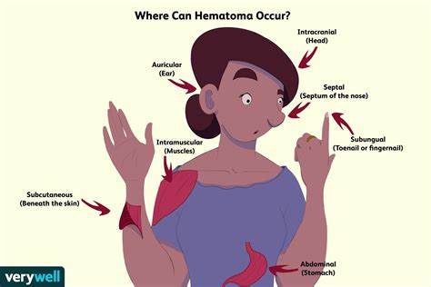 Hematoma: Types, Causes, Treatment, and More