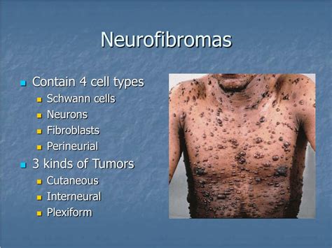 Neurofibroma Type 1