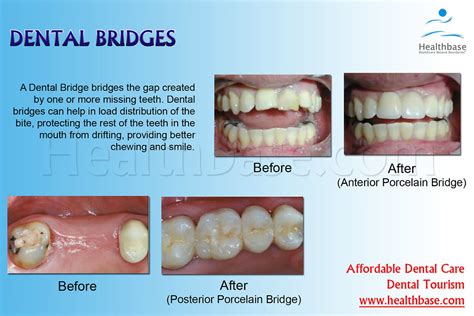 Dental Bridges | For affordable Dental Bridges procedure log… | Flickr